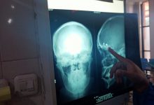 Photo of Pria di Kediri Selamat Meski 2 Peluru Bersarang di Kepala